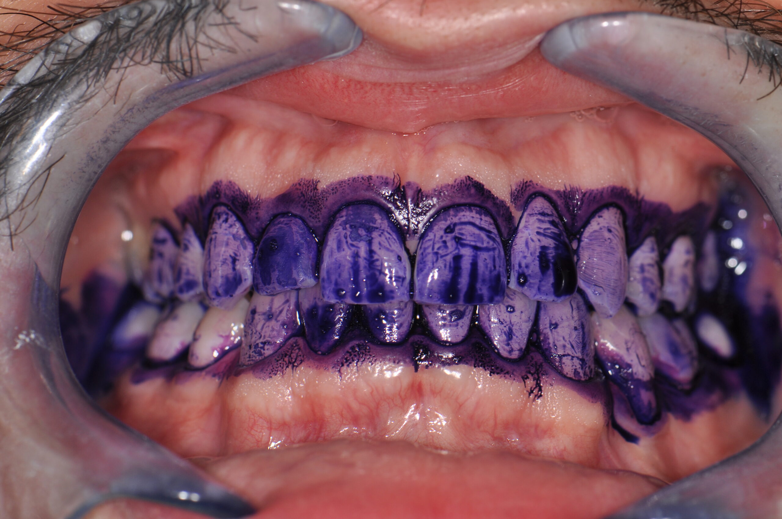 Plaque dentaire avant traitement parodontologie Dr Tanasescu cabinet C2S Paris 8e