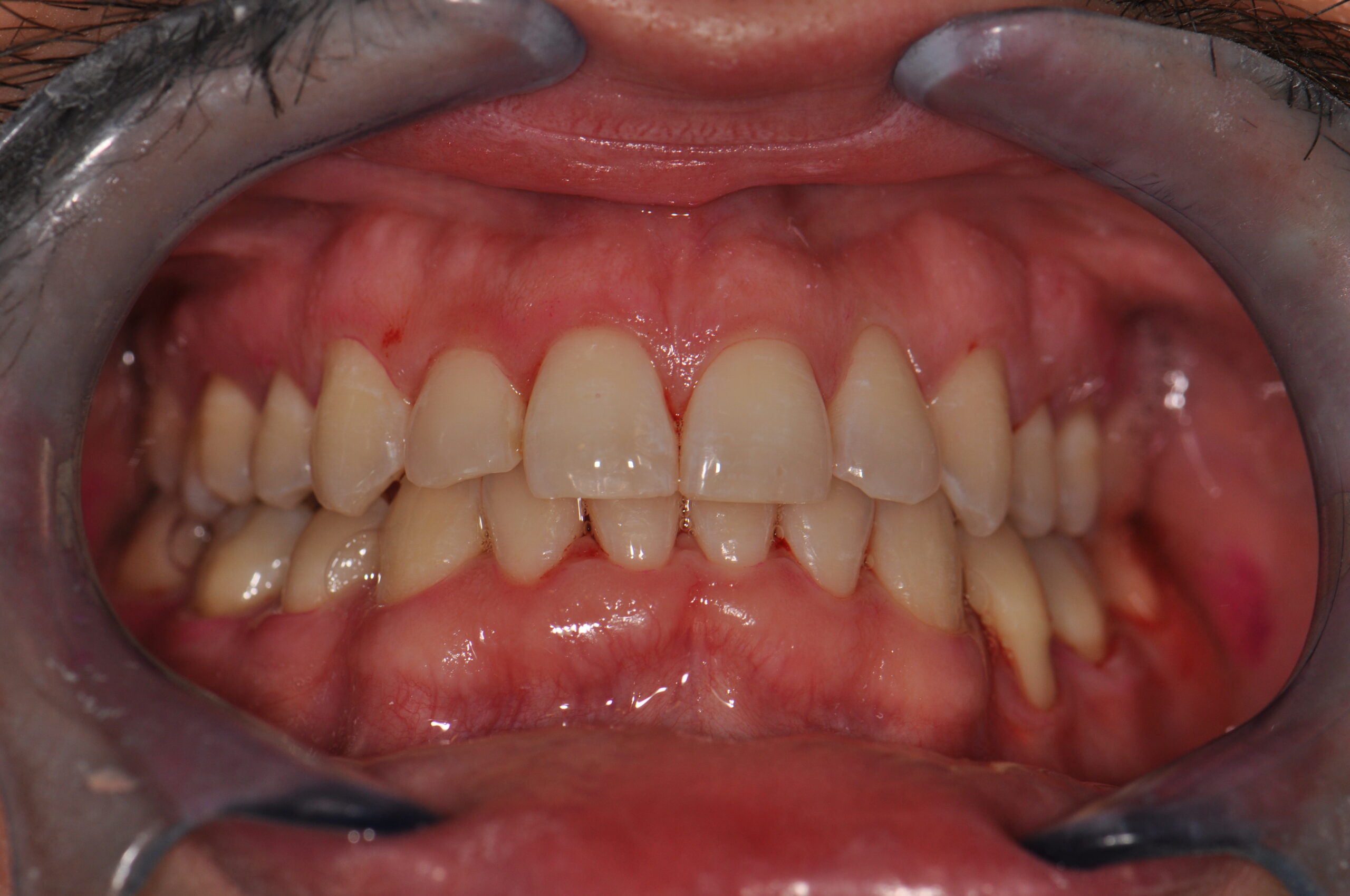 Gencives après traitement parodontologie Dr Tanasescu cabinet C2S Paris 8e